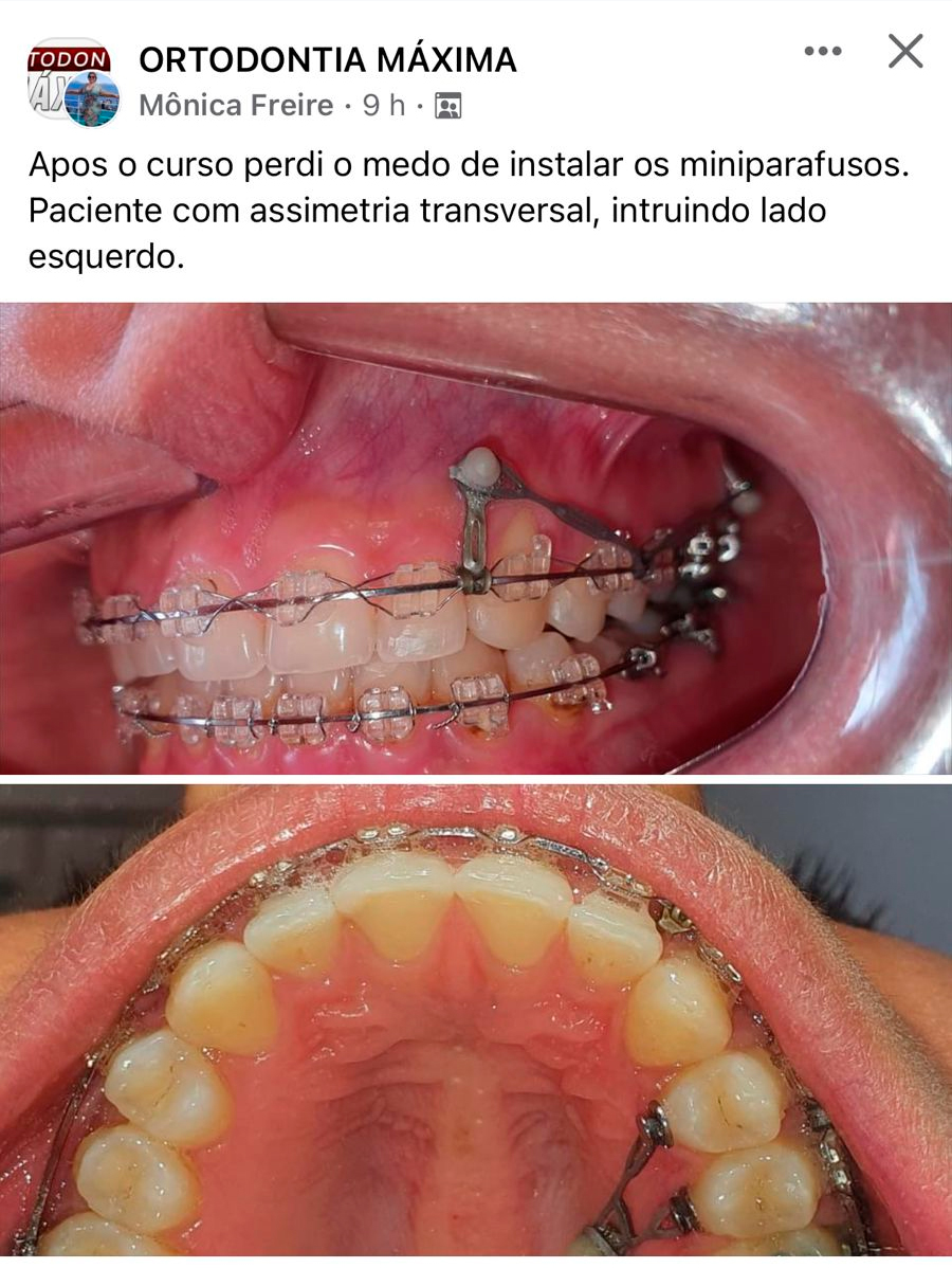 Depoimento de aluno 1 do Ortodontia Máxima